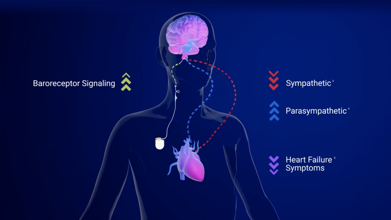 Barostim Mechanism of Action Animation